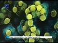 Un hombre afectado por la bacteria come carne pierde un brazo