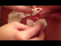 Cyst removal two
