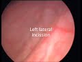 Greenlight HPS laser prostatectomy 130 grams Greenlight HPS laser prostatectomy 130 grams