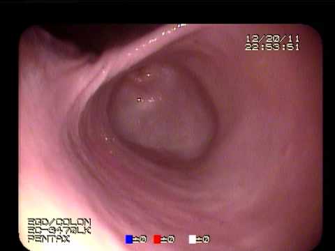 how to fasten dilation