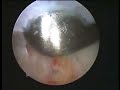 elbow arthroscopy loose body removal ???????????????
