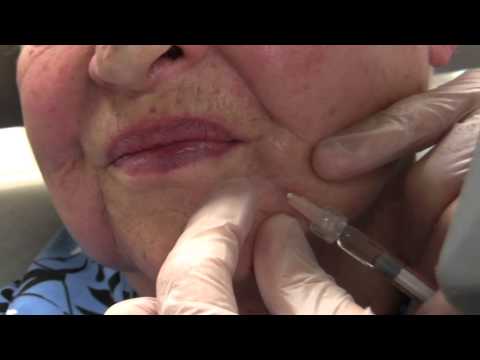 how to dissolve belotero