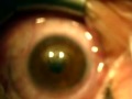 Femto L D V / VISIX Laser Treatment