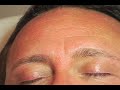 Watch EYE WRINKLES: www.youtube.com Dramatic Video of Botox Before and After on the forehead lines and furrows lines. Botox, when performed by a trained professional, is a reliable means of wrinkle reduction of lines of motion. A treatment commonly used by dermatologists to get rid of facial wrinkles.