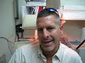 PATIENT WITH ADVANCED KERATOCONUS WITH HYDROPS WEARING SCLERAL LENSES