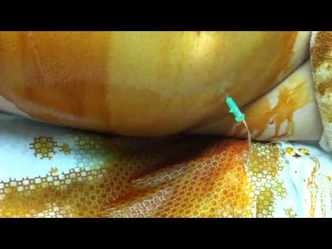 how to treat mild ohss