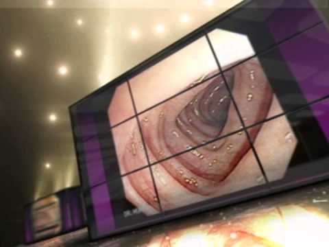 Rectal Prolapse