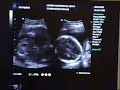 el bb 2 katheryn y gabriel