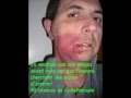 arreter de fumer