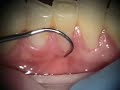 Correction of Poorly Fabricated Dental Restorations