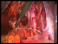 Laparoscopic Radical hysterectomy pelvic paraaortic LND