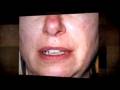 chemical peels before and after pic