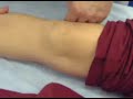 Knee Effusion 2