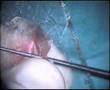 tympanoplasty