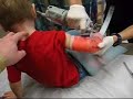 Evan Gets His Cast Off Evan Gets His Cast Off
