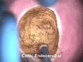videos de Colposcopía - Cono de Cérvix