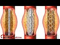 Insidermedicine in 60 - February 13, 2008  Cancer Docetaxel