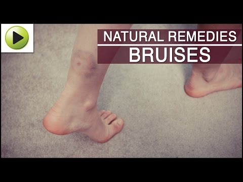 how to cure bruises