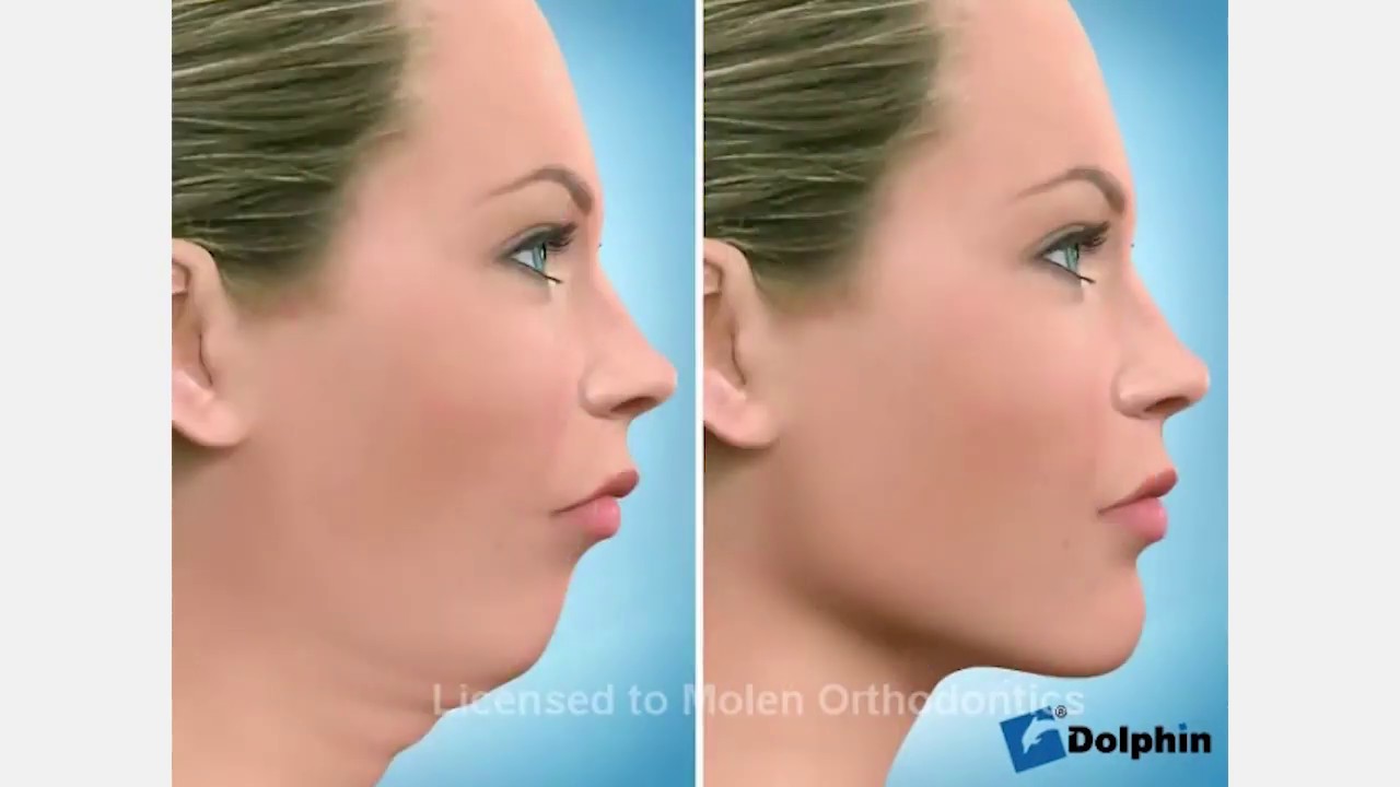 Ortognática avanço mandíbula