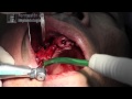 Sinus lift, PRP and post-extraction with GMI implants