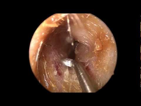 how to remove ear wax