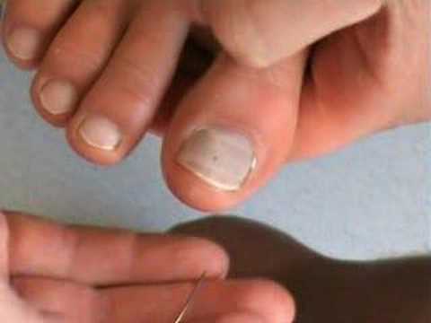 how to drain bruised toenail