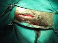 Simple continuous suture pattern