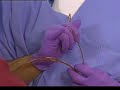 CryoSpray-Ablation-B