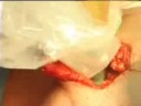 The Novel Technique of TARGeted Interoperative RadioTherapy The Novel Technique of TARGeted Interoperative RadioTherapy
