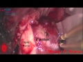 Sugical resection of a tuberculum sella meningioma after anterior clinoidectomy.mov
