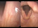 Laryngology 101 - Reflux Laryngitis