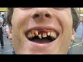 Patrick Greer's Shattered Teeth Dec 12, 2008