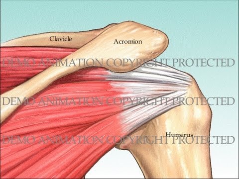 decompression - Arthroscopic repair of torn rotator cuff with suture anchor placed into humeral tuberosity. Subacromial decompression by removing subacromial spurs with bone...