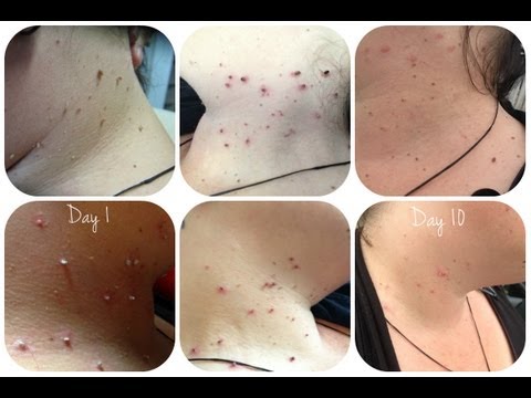 how to remove skin tags at home with vinegar