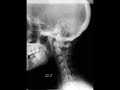 Cervical Morph Video