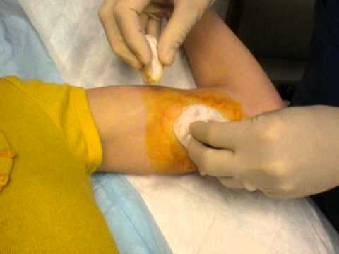 how to insert vcf birth control