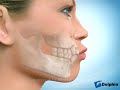 Removal of Four 1st Premolars to Reduce Lip Fullness