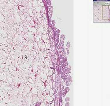 Histopathology Lung, pleura-- ...