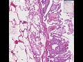 Histopathology Lung, pleura--Mesothelioma Histopathology Lung, pleura--Mesothelioma