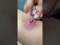 Aj pops his cyst part3