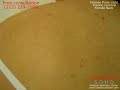 LaserTouch SoHo IPL.wmv