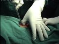 Medical thoracoscopy - Trocar insertion