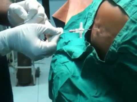 how to remove epidural catheter