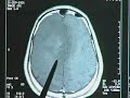 Brain Tumor - Part 2