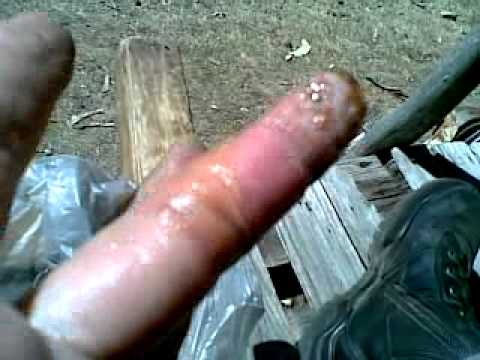 how to treat avulsion