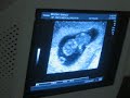 9 weeks 4 days Ultrasound