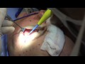 Facelift Surgery in 10 Minutes