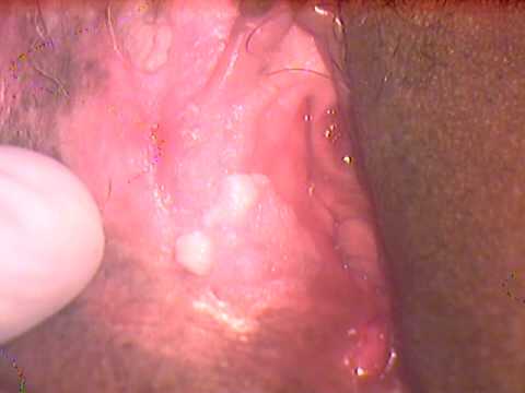 vulva