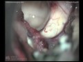 Intraventricular ependymoma - Frontal transsulcal approach