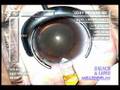 Cataract Surgery - Corneal Incision Cataract Surgery - Corneal Incision